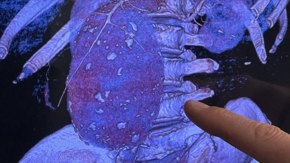 Aort Damarı Hastalıklarına Karşı Kalp Sağlığını Korumada Yaşam Tarzı Da Öne Çıkıyor