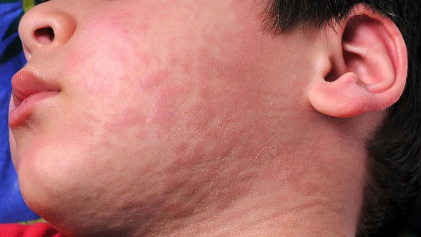 Toz Alerji Leke (1)-1