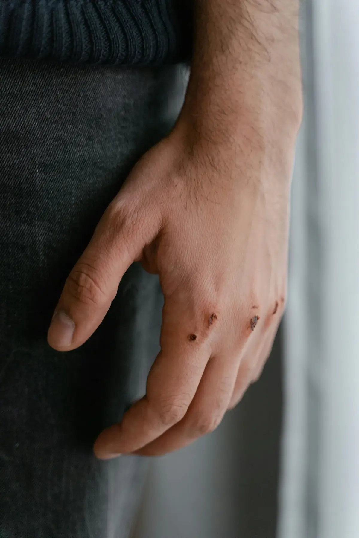 Uyuz Hastalığı (1)