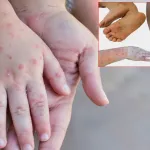 Hataylı Aileler Dikkat: Çocuğunuzda Bu Belirtiler Varsa Bulaşıcı Hastalık Olabilir!