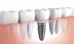 “Dişte Devrim! İmplant Artık Ücretsiz Mi Oluyor?