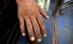 Uyuz Vakalarında Rekor Artış: Uzmanlardan Acil Uyarı