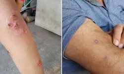 Hatay’da Uyuz Alarmı: Vakalar Yeniden Artış Gösterdi