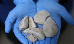 İdrar kanalı ve mesanesinden yarım kilogram ağırlığında 6 taş çıkarıldı