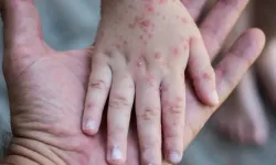 Ailelere Uyarı: Çocuklarda Görülen Salgın Hastalık Yayılıyor!