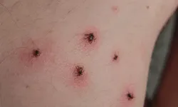 Hatay'da Kene Alarmı: Yağışlar Sonrası Risk Büyüyor!