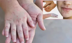 Hataylı Aileler Dikkat: Çocuğunuzda Bu Belirtiler Varsa Bulaşıcı Hastalık Olabilir!