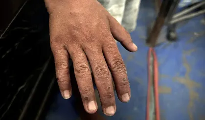 Uyuz Vakalarında Rekor Artış: Uzmanlardan Acil Uyarı