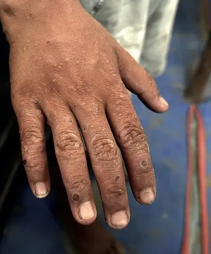 Uyuz Vakalarında Rekor Artış: Uzmanlardan Acil Uyarı