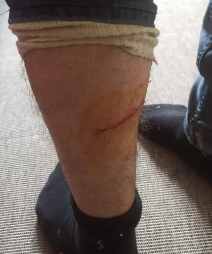 Hatay'da Kuduz Paniği: Vatandaş Köpek Saldırısına Uğradı!