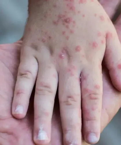 Ailelere Uyarı: Çocuklarda Görülen Salgın Hastalık Yayılıyor!