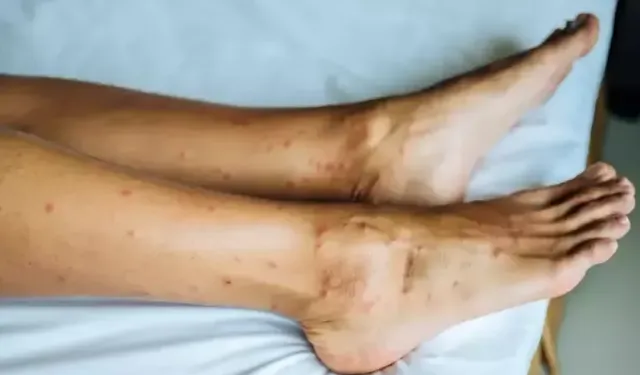 Hataylılar Endişeli! Yakarca Sineği Tehlikesi Büyüyor