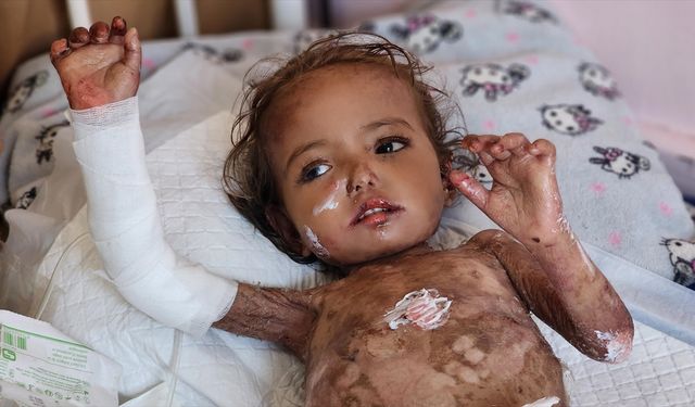 Gazze'de kelebek hastası Yakin bebek, tıbbi malzeme eksikliği ve İsrail ablukasının pençesinde