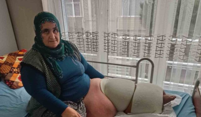 Fil hastalığı bacağını 100 kilo yaptı, tedavisinin devamı için destek bekliyor