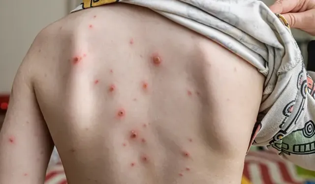 Okullarda Suçiçeği Alarmı: Veliler Endişeli!