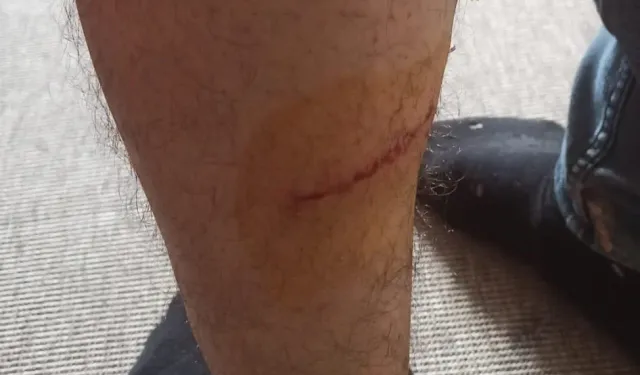 Hatay'da Kuduz Paniği: Vatandaş Köpek Saldırısına Uğradı!