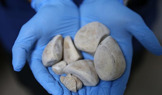 İdrar kanalı ve mesanesinden yarım kilogram ağırlığında 6 taş çıkarıldı