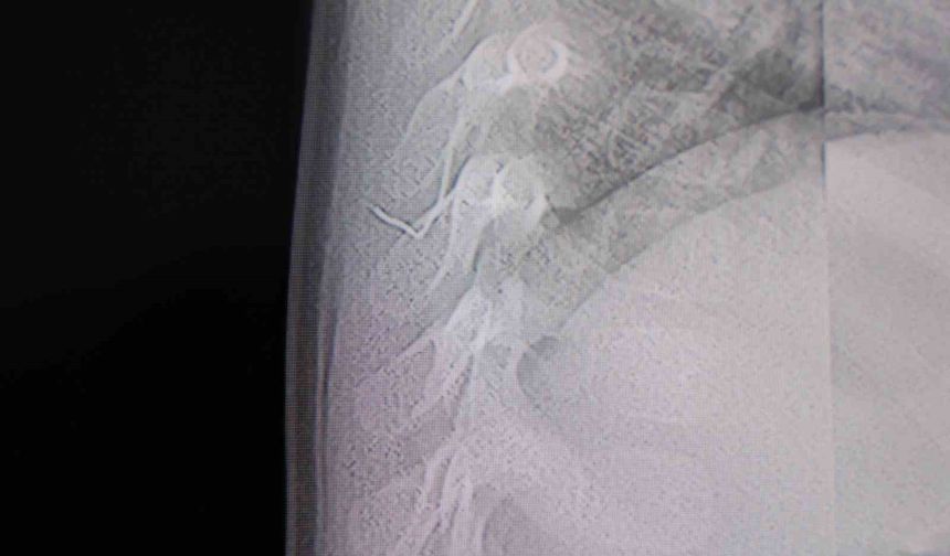 Bebeğin sırtından tel parçası çıktı