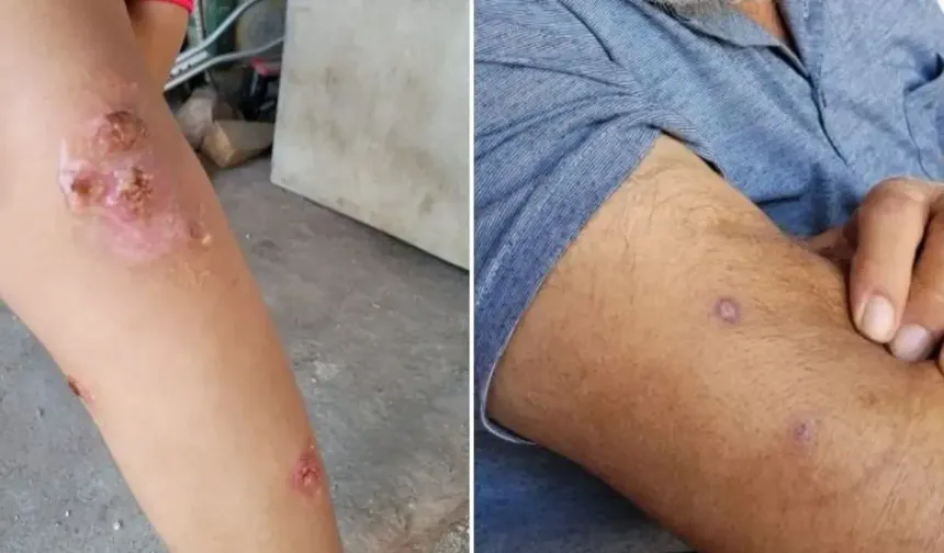 Hatay’da Uyuz Alarmı: Vakalar Yeniden Artış Gösterdi