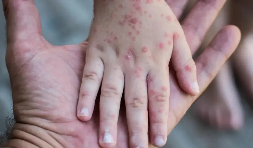 Ailelere Uyarı: Çocuklarda Görülen Salgın Hastalık Yayılıyor!